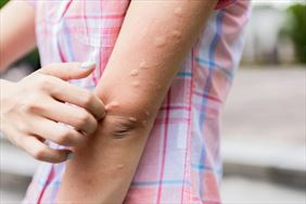 testy alergologiczne, Romuald Olszański, prof. dr hab. med. Gabinet medycyny estetycznej, dermatologii i alergologii, Gdynia