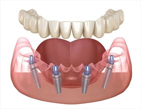 pracownia protetyczna, AS Dental. Sekuła A., Ruda Śląska