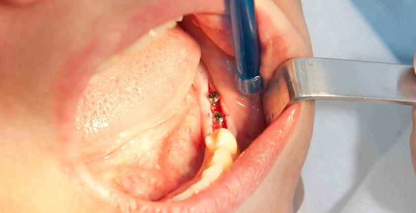 Powody, dla których warto zdecydować się na założenie implantów stomatologicznych w prywatnej przychodni Dentus! Powody, dla których warto zdecydować się na założenie implantów stomatologicznych w prywatnej przychodni Dentus!