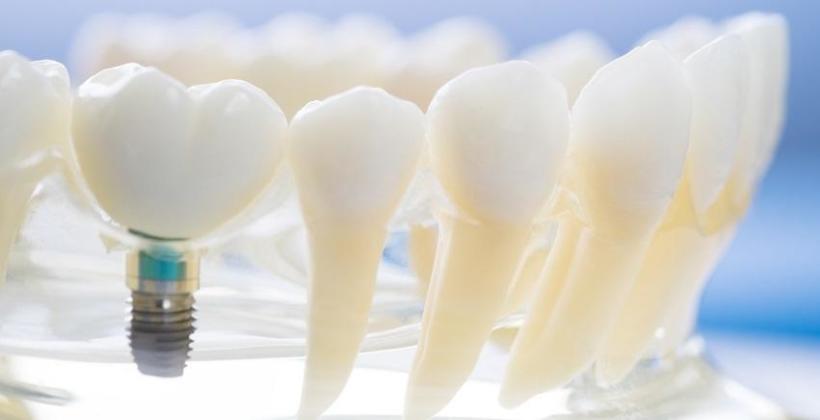 Rodzaje implantów zębowych Rodzaje implantów zębowych