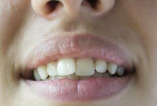 Leczenie wad zgryzu - kiedy i dlaczego jest potrzebne?