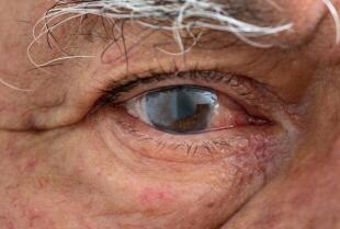 Specjalistyczny Ośrodek Okulistyczny: Jaskra - przyczyny, objawy i możliwe metody leczenia